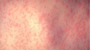 measles2